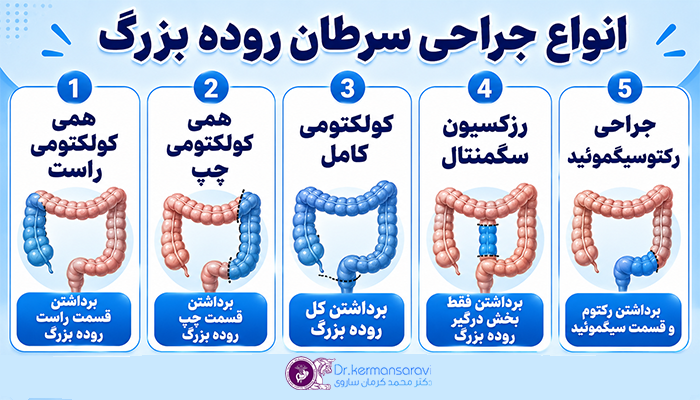 انواع جراحی سرطان روده بزرگ