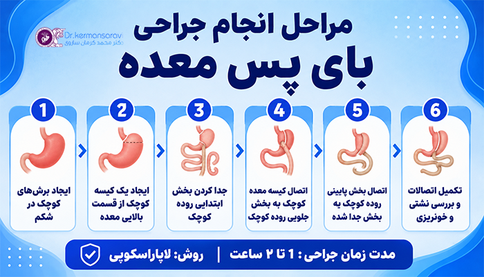 مراحل انجام جراحی بای پس معده