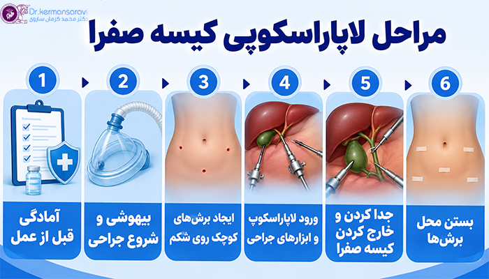 مراحل لاپاراسکوپی کیسه صفرا